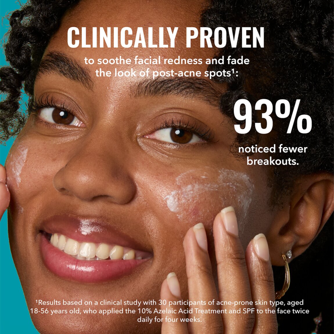 10-azelaic-acid-treatment-w5 zb_p.jpg