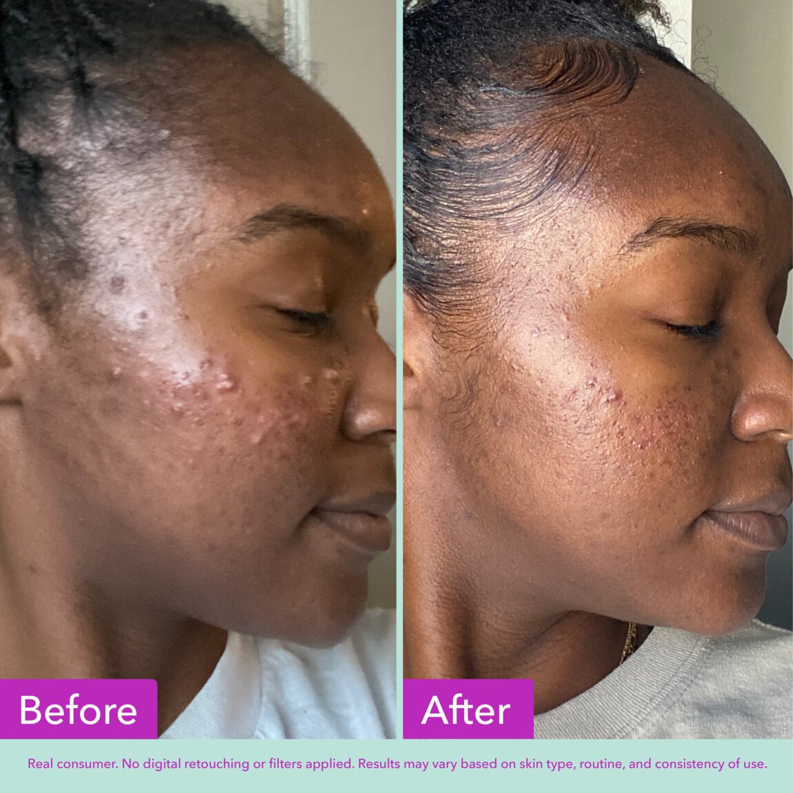 acne-foaming-cleanser-a9 zb_p.jpg
